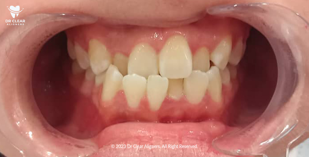 crooked teeth problem dr clear aligners