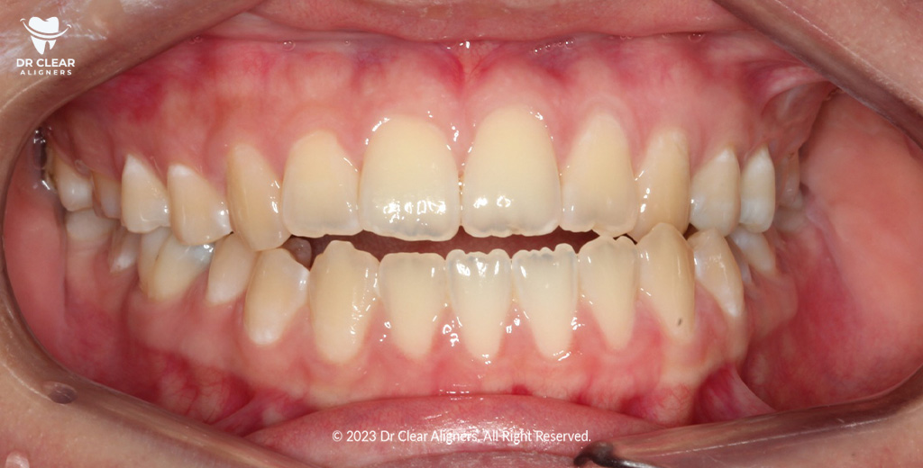 openbite teeth problem dr clear aligners