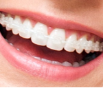 Ceramic Braces