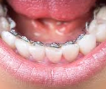 Lingual Braces