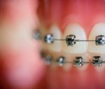 Metal Braces