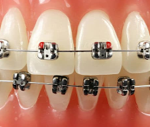 Self Ligating Braces
