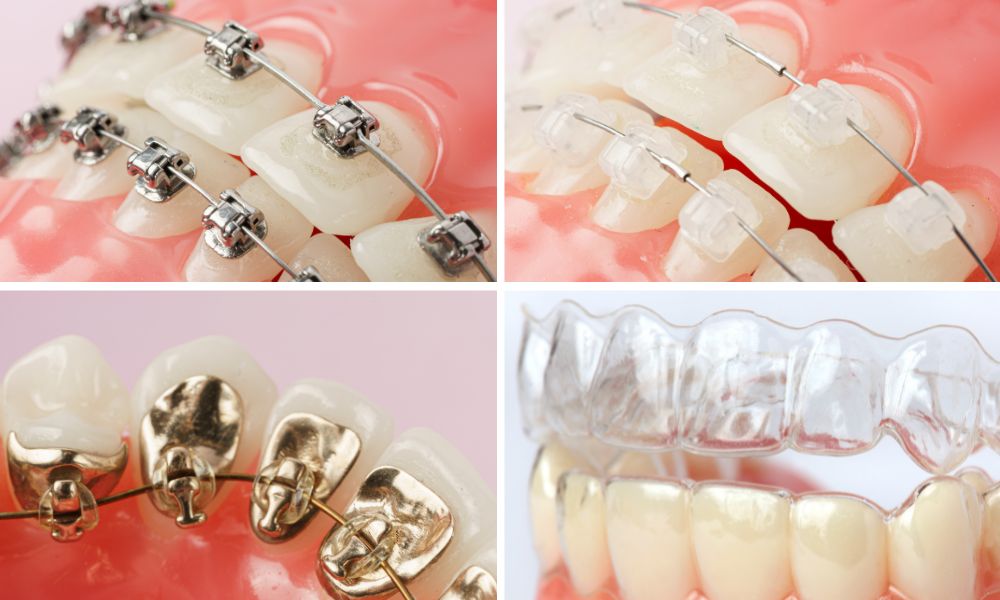A Comprehensive Guide to How Braces Work: Metal, Invisible