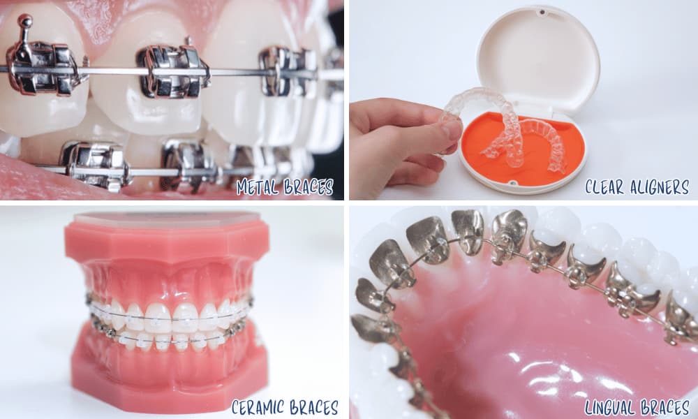 Discover How Braces Effectively Correct Overbites