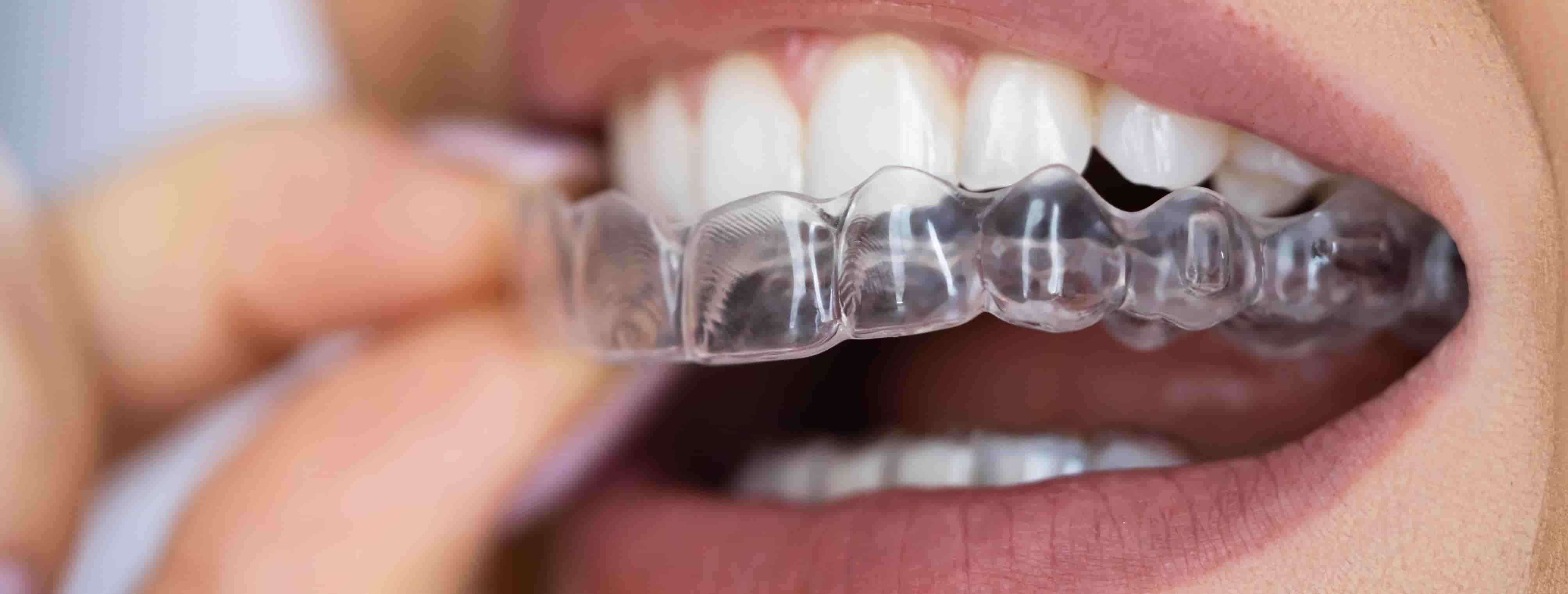 Clear aligners used for discreet teeth straightening in Singapore