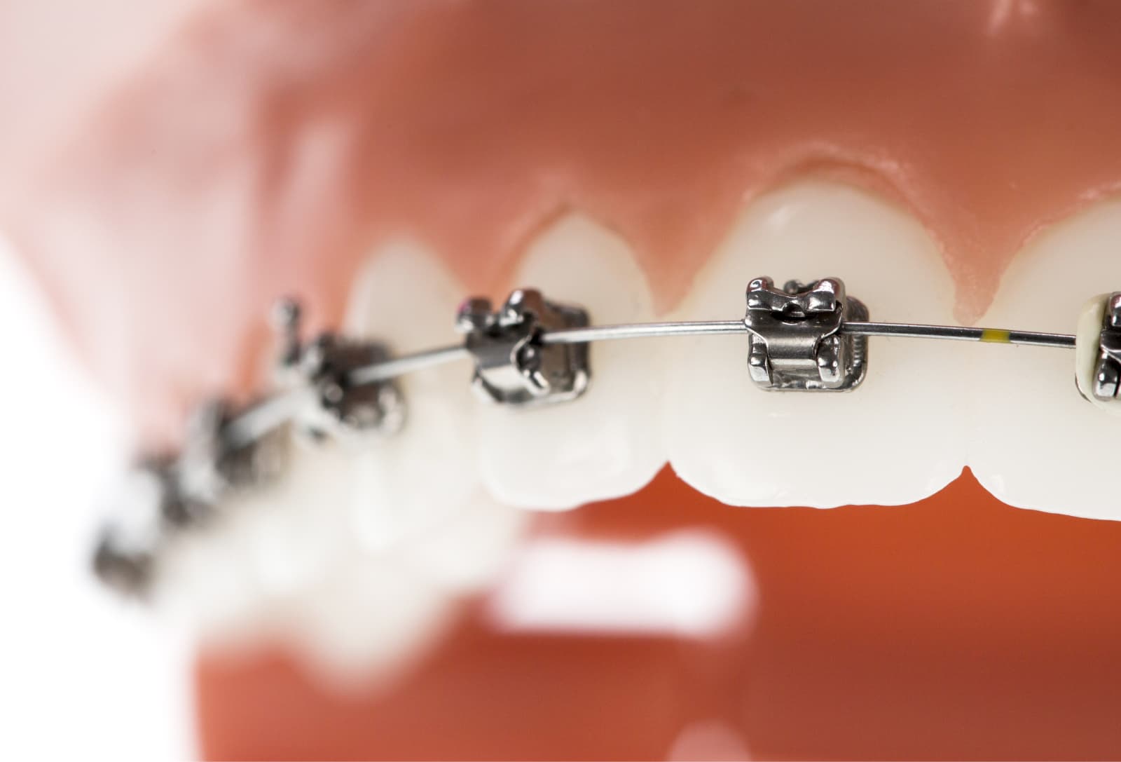 Metal braces for teeth straightening and bite correction