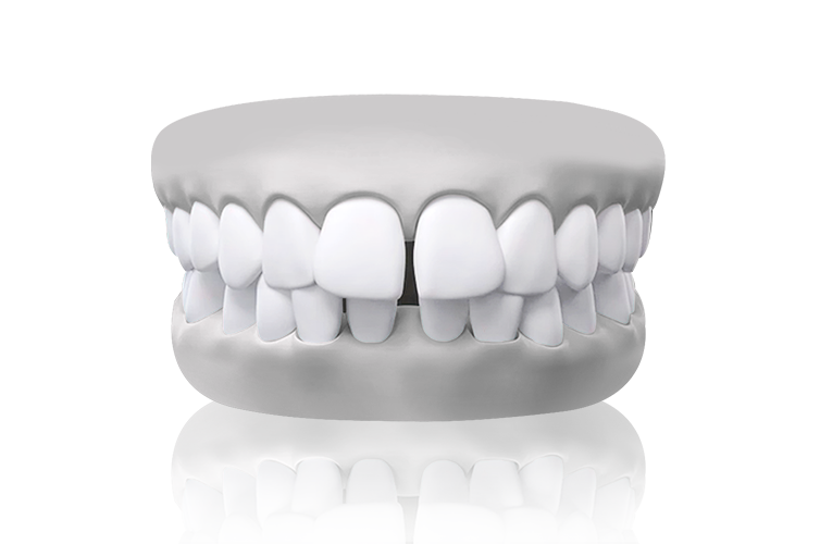 malocclusion teethgap