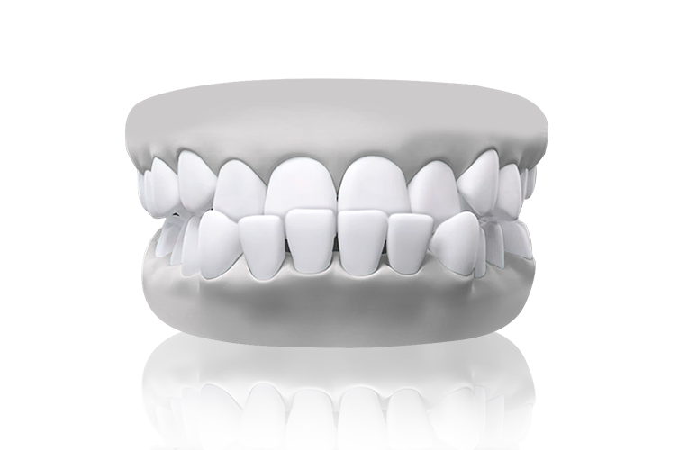 malocclusion underbite